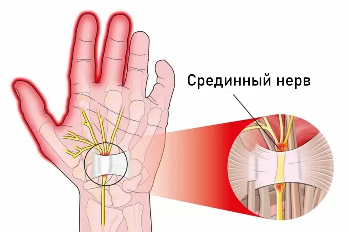Туннельный синдром (карпальный синдром)