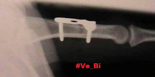 Рентгенограмма перелома и фиксирующего элемента в мизинце Марка Маркеса (вторник, 28 апреля 2015) 