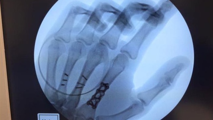 Рентген после операции: Данило Петруччи сломал три фаланги правой кисти при падении в Phillip Island