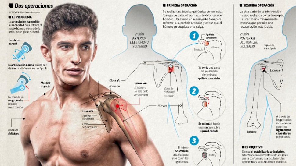 Инфографика от Marca: суть операции на плече Маркеса