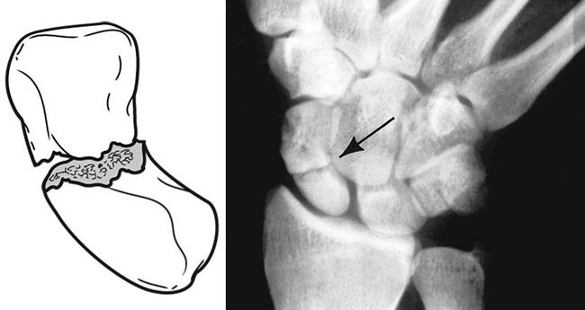 Типичный перелом ладьевидной кости (рентген - не Лоренцо)