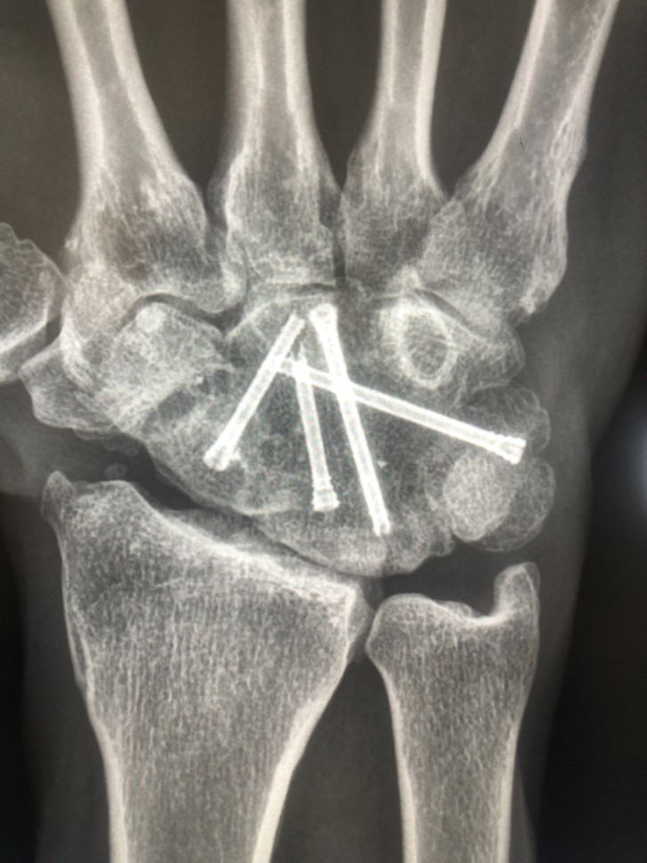 Рентгеновский снимок руки Джеймса Тозланда: с момент рецидивной травмы прошло более 10 лет!