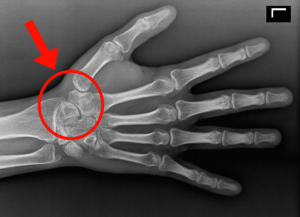 Снимок кисти руки рентген здорового человека фото