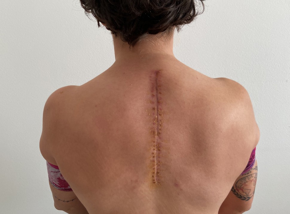 Последствия травмы и ряда операций: 12 января с позвоночника Ани Карраско сняли металлические импланты