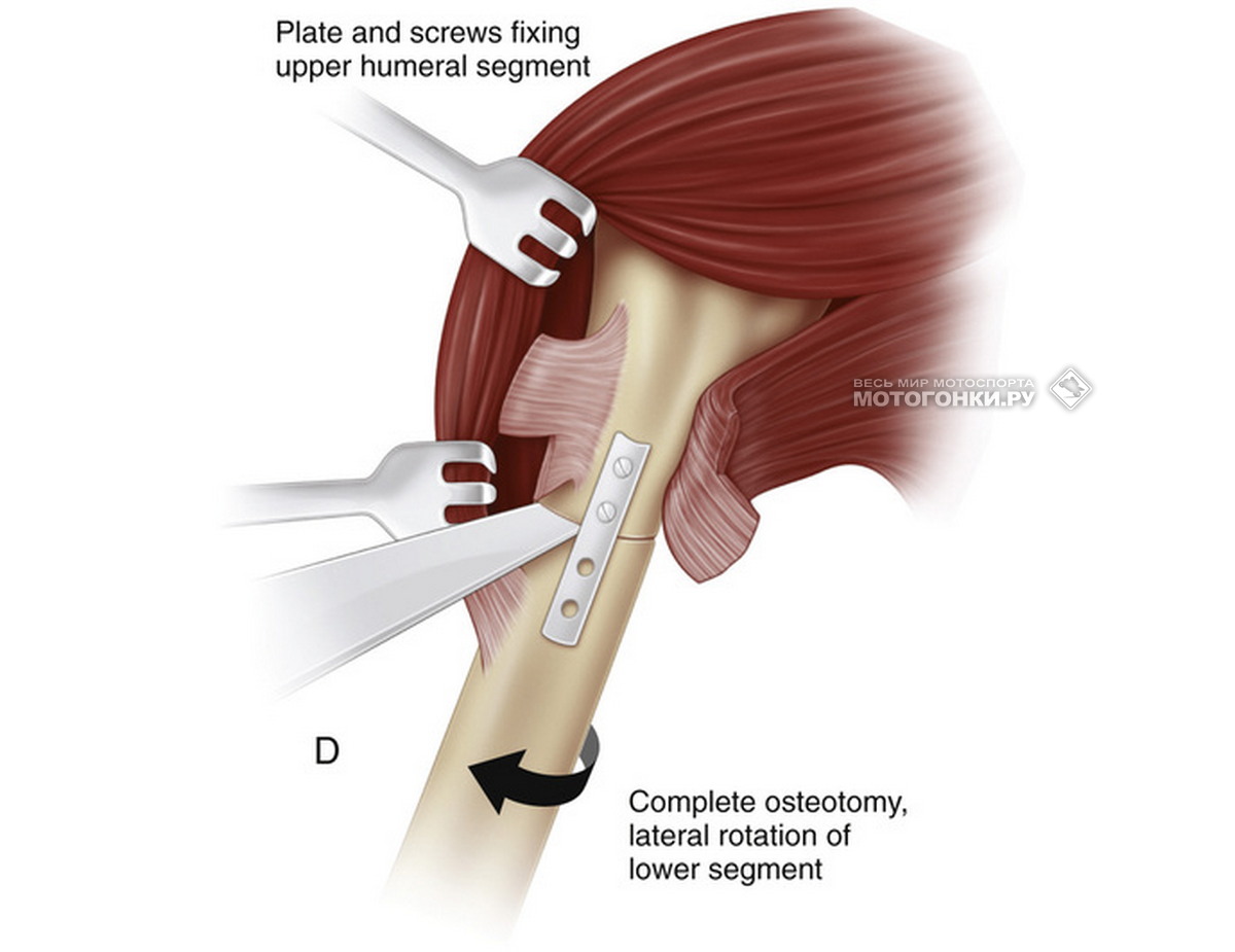 Схема 4-й операции плечевой кости Марка Маркеса