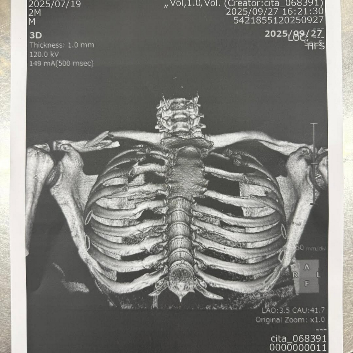 Рентгеновский снимок Хорхе Мартина