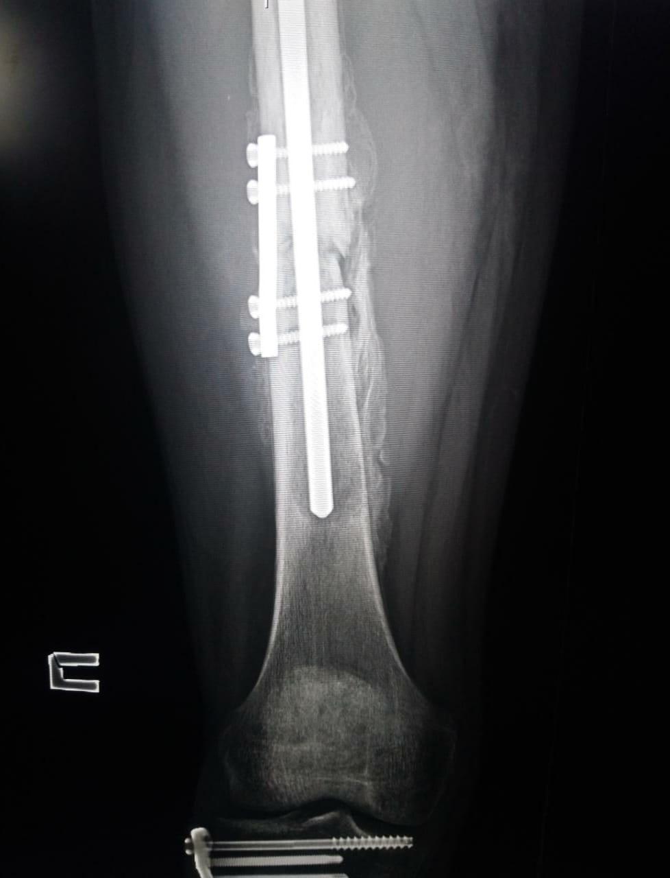 Пример оперативной фиксации диафиза бедра