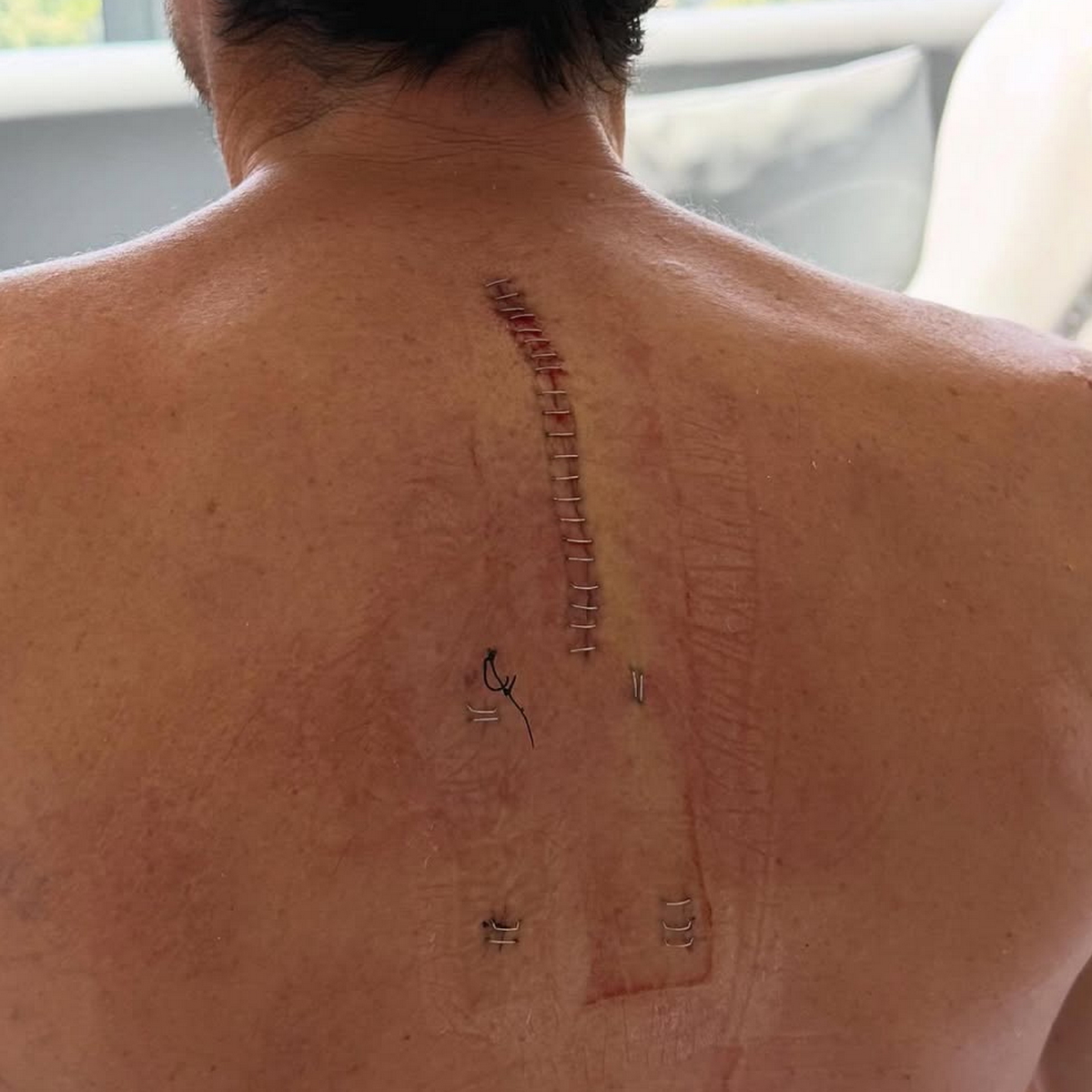 Алеш Эспаргаро в больнице: операция на четырех позвонках