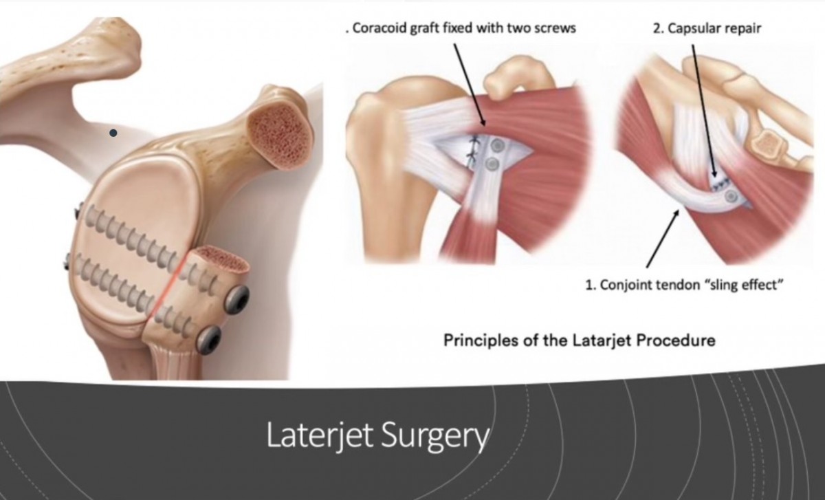 Технология Laterjet